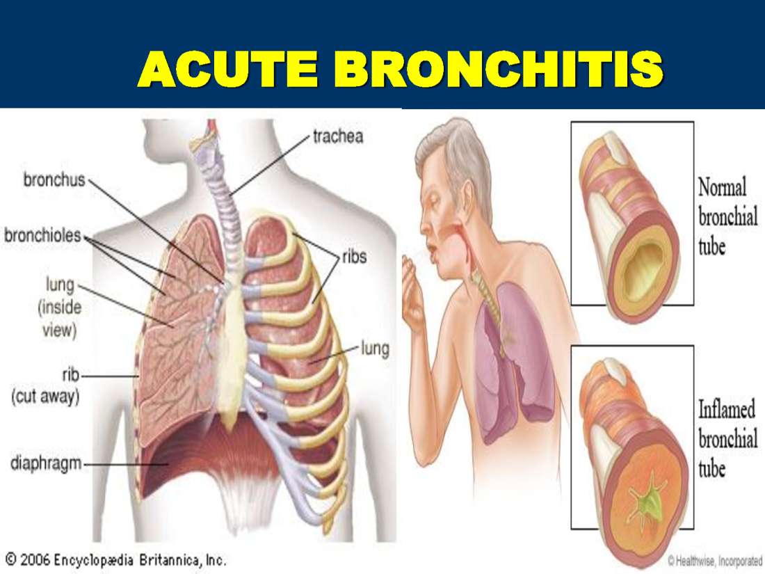 Acute Bronchitis FAQs | Signs & Symptoms and How to Treat it